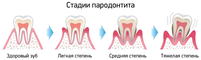 Стадии прогрессирования пародонтита