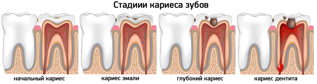Стадии кариеса зубов