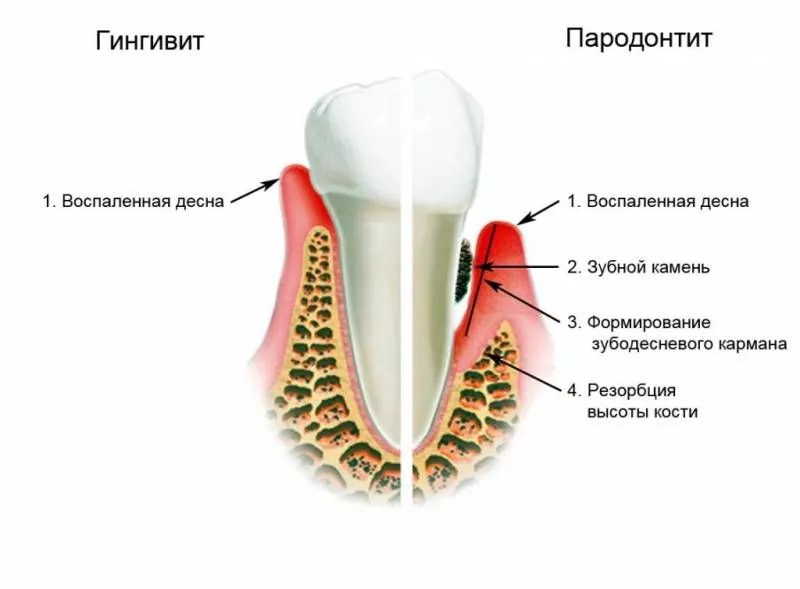 Воспаление десен