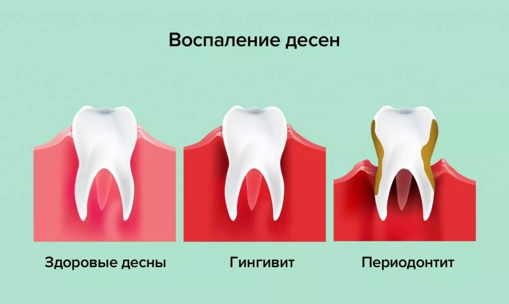 Кровоточивость десен