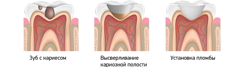 Процесс пломбирования зуба